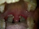 Tonsillectomy Recovery Time Images