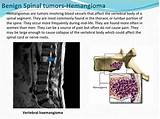 Photos of Hemangioma Spine Treatment