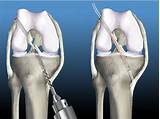 How Long Is Recovery After Acl Surgery Pictures