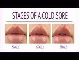 Medication To Stop Cold Sores
