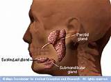 Images of What Is The Treatment For Mumps Disease