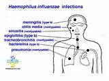 Meningitis Vaccine Side Effects Treatment Pictures
