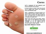Foot Corn Home Remedies Pictures