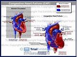 Pictures of Congestive Heart Failure Treatment Guidelines
