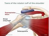 Pictures of Physical Therapy For Rotator Cuff Surgery Recovery