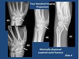 Photos of Scaphoid Fracture Treatment Options