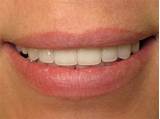 Images of Silver Treatment For Cavities