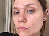 Makeup For People With Acne Images