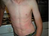 Allergic Reaction To Nuts Treatment Photos