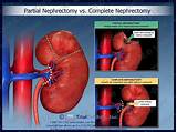 Pictures of Partial Nephrectomy Recovery