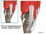 Acl Hamstring Graft Recovery Photos