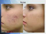 Acne Laser Treatment Nyc Images