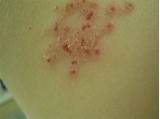 Images of Do I Need To See A Doctor For Shingles