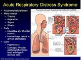 Respiratory Distress Syndrome Treatment Photos