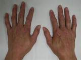 Scleroderma Mayo Clinic Pictures