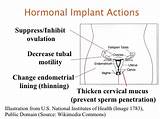 Implantable Contraception Side Effects