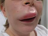 Images of Allergic Reaction Swollen Tongue Treatment