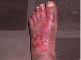Severe Foot Fungus Treatment Images