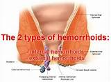 Which Doctor Do You See For Hemorrhoids Images