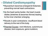 Management Of Dilated Cardiomyopathy Pictures