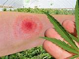 Pictures of Marijuana Lyme Disease