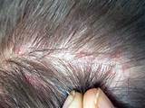 Can You Use Lice Treatment For Bed Bugs Pictures