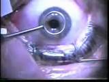 Images of Lasik Eye Surgery Complications Statistics