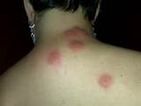 Images of After Bed Bug Treatment Bites
