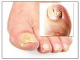 Photos of Severe Foot Fungus Treatment