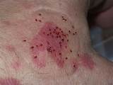 Treatment For Bed Bugs In Skin