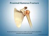 Broken Humerus Bone Recovery Time Images