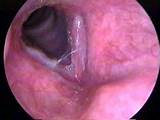 Images of Home Remedies For Swollen Epiglottis