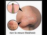 Pictures of Face Black Spot Removal Natural