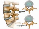 Pictures of Chiropractic Treatment For Bulging Disc In Lower Back
