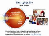 Lasik Fluctuating Vision Photos