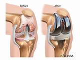 What''s The Recovery Time For A Knee Replacement