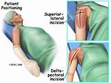Images of Shoulder Joint Replacement Surgery Recovery