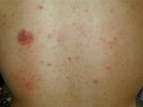 Images of Skin Heat Rash Treatment