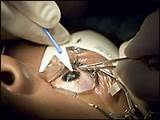 Risks Of Lasik Eye Surgery 2013
