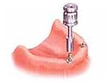 Pictures of Dental Implants Santa Clara