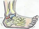 Loose Ligaments In Ankle Treatment Images