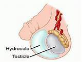 Pictures of Hydrocele Home Remedies