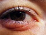 Images of Upper Eyelid Infection Home Remedies