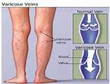 Images of Exercises Varicose Veins