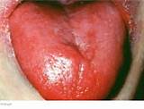 Images of Tongue Cracks Home Remedies