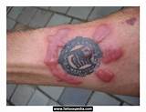 Images of Henna Tattoo Allergy Treatment