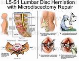 Recovery From Slipped Disc Surgery Images