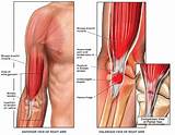 Images of Lower Bicep Tendonitis Treatment