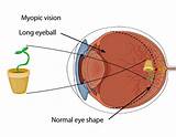 Pictures of Blurred Vision Medical Term