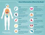 Can Ankylosing Spondylitis Cause Weight Loss Pictures